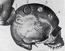 В древней Фракии делали трепанации черепа